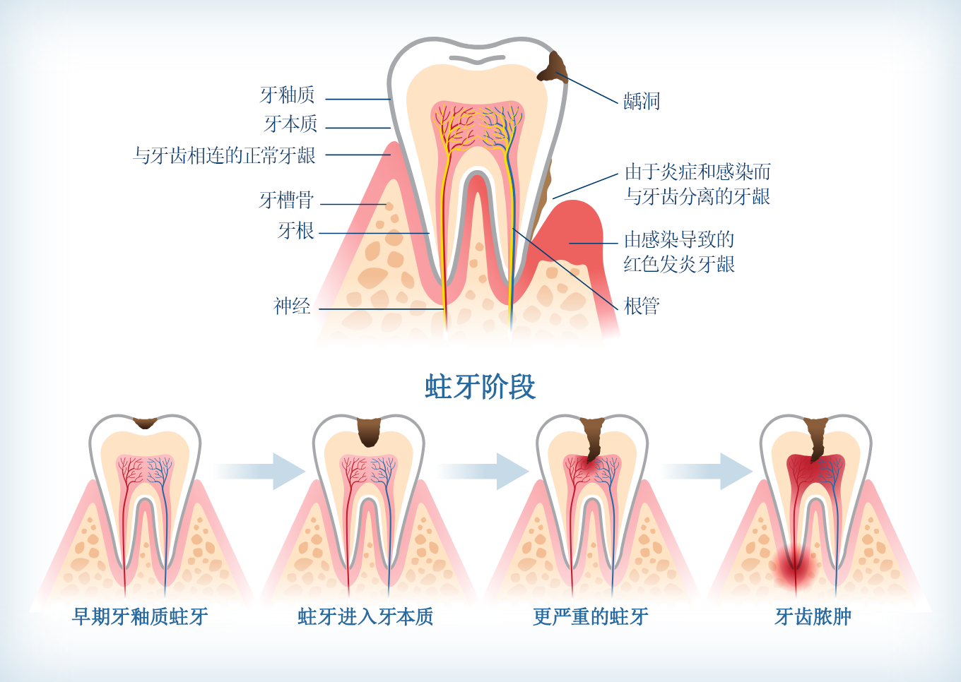 显示蛀牙从早期牙釉质蛀牙到牙齿脓肿的各阶段进展信息图。